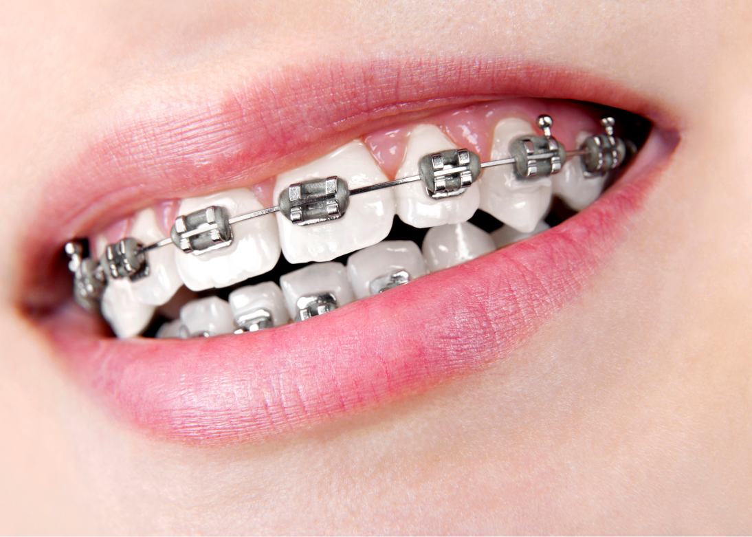 Metal, Ceramic & Self-Ligating Braces